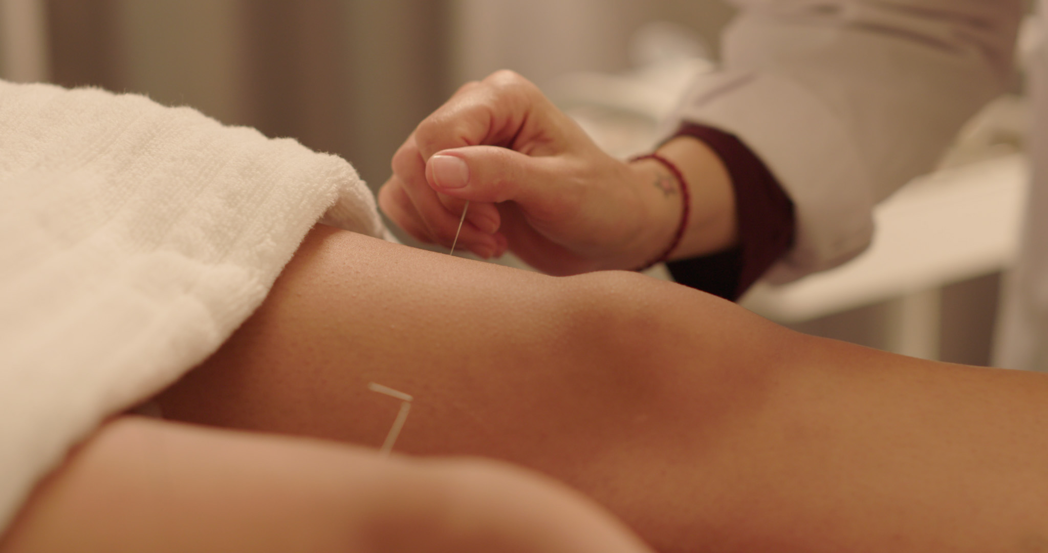 Acupuncture application of needles